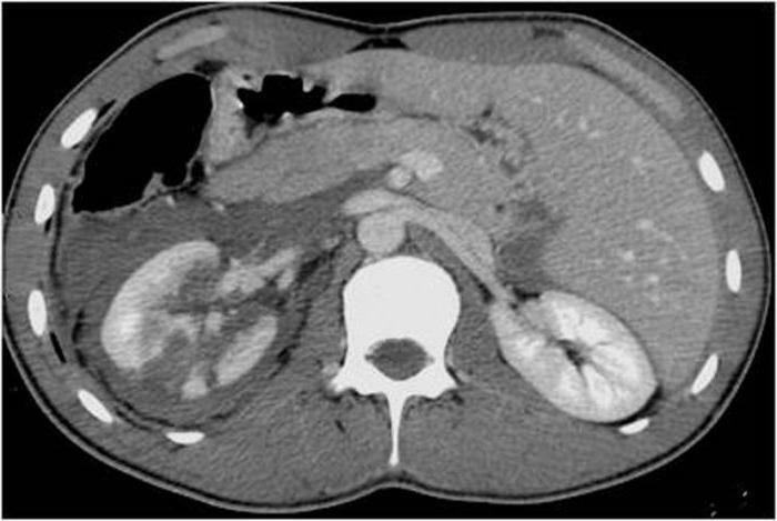 computed tomography of kidney kt