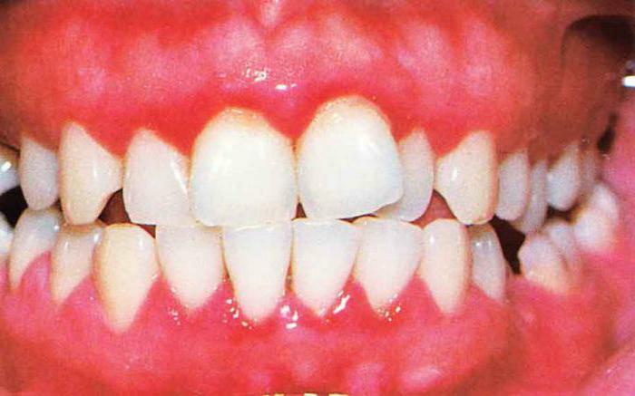 akut gingivitis