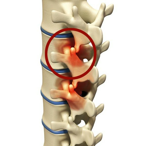 spondylartrózy lumbosakrálnej chrbtice