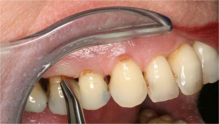 chronic granulomatous periodontitis