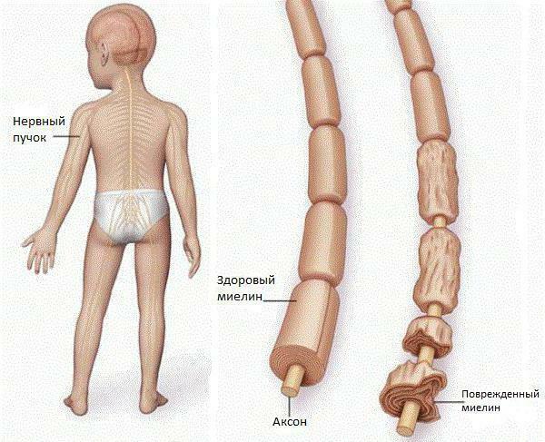 أعراض شلل الأطفال عند الأطفال