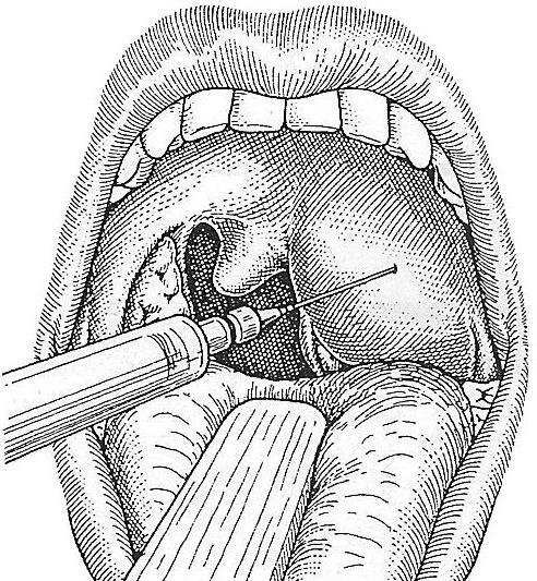 abscess and phlegmon