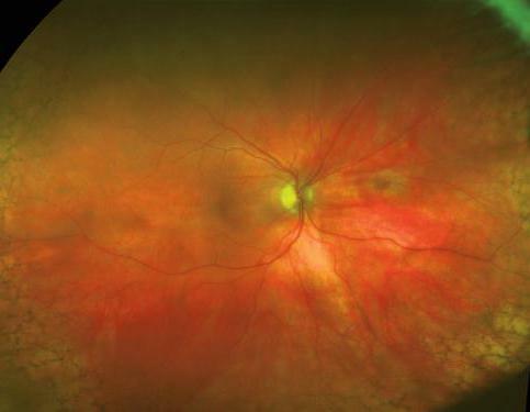 retinal periphery