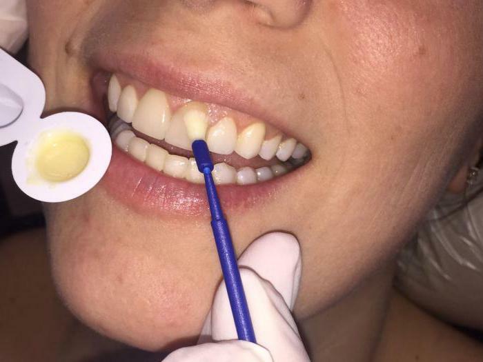 whitening tetracycline teeth reviews