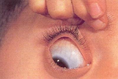 scleral inflammation