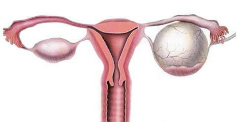 from which there is a cyst in women