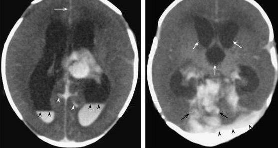 intracranial hematoma