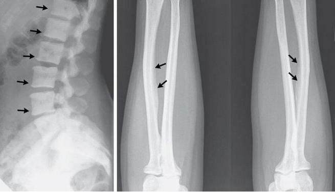 inflammatory diseases of bones