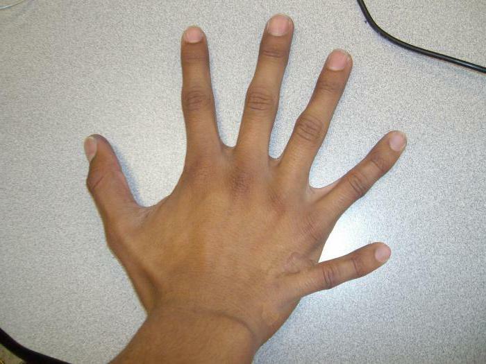 copil cu șase degete în mână