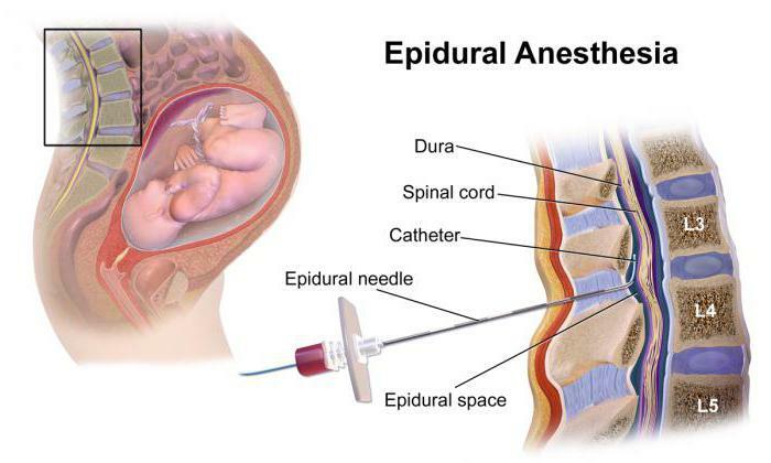 Peridural anesthesia in childbirth