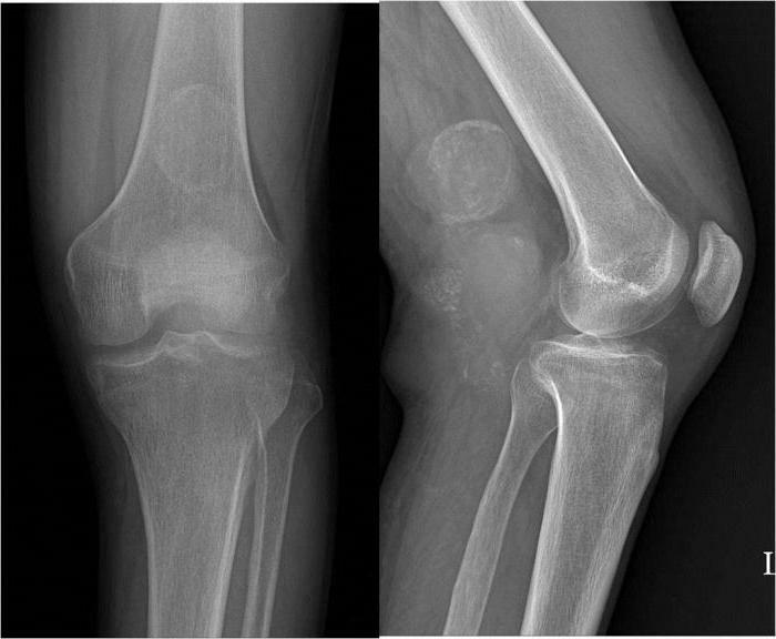 synovial sarcoma of stage 3