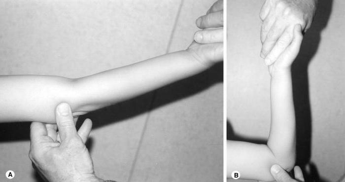 mcb fracture of forearm
