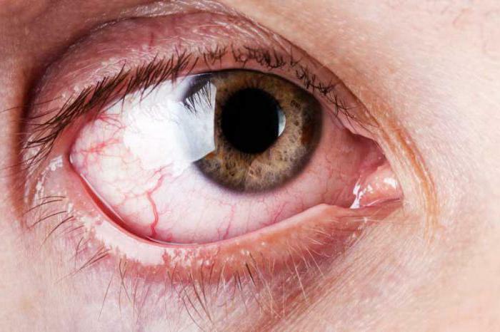 redness of the eye causes and treatment