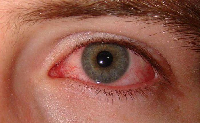 sclera diseases