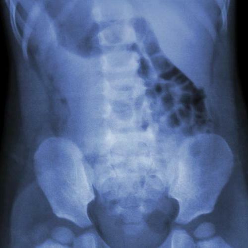 X-ray of the lumbar spine