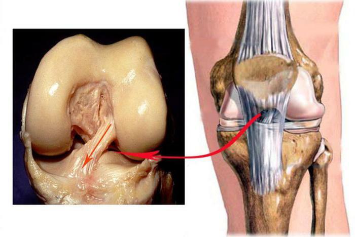 inflammation of the ligaments of the knee joint