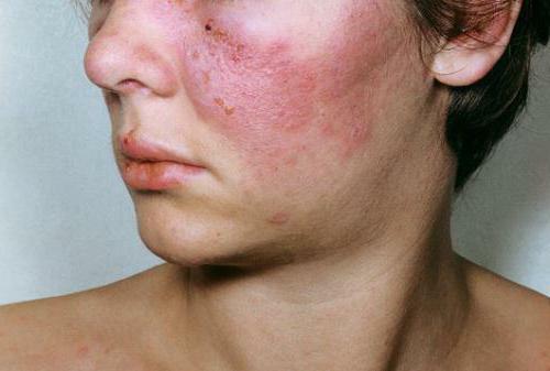 collagen disease