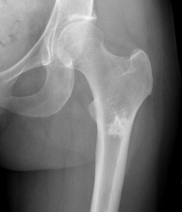 of the thigh bone endochondrum