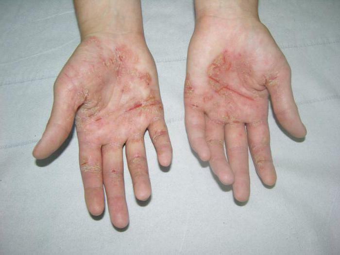 microbial eczema treatment ointment