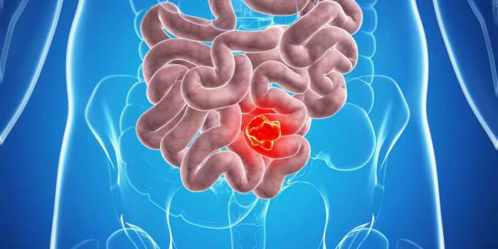 sigmoid tumor