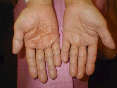chronic eczema of hands treatment