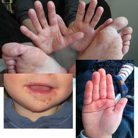 rash on the feet and palms of the child