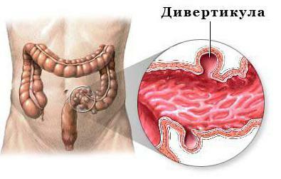 diverticulosis intestines treatment diet