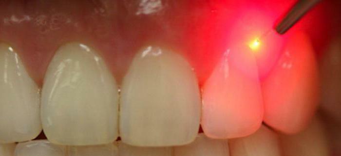 removal of the laser cyst of the tooth