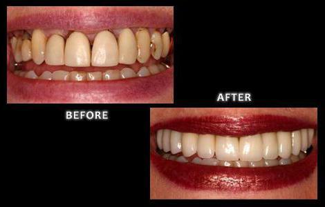Ceramic crowns before and after photos