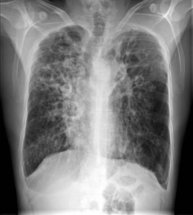 bronchiectasis of the right lung