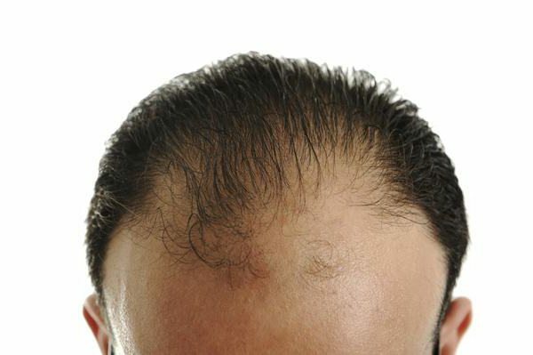 Is there a cure androgenetic alopecia