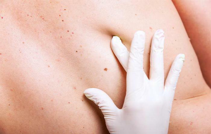 melanoma skin projections of life after surgery