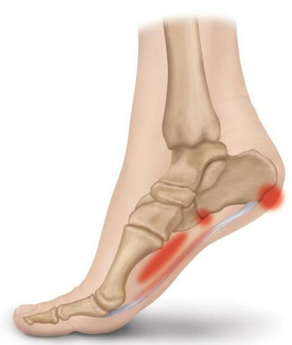 heel spur which doctor heals