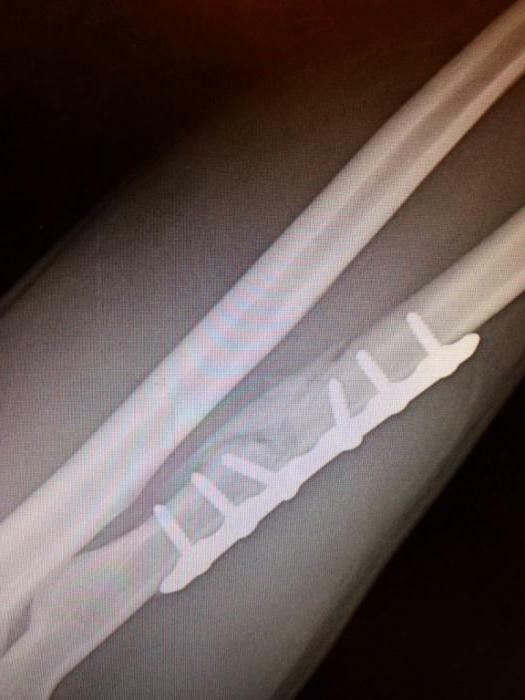 fracture of the forearm
