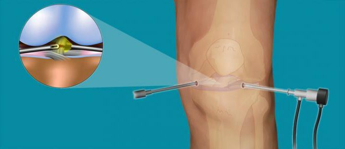 costul chirurgiei artroscopice pentru condromentoza articulației genunchiului