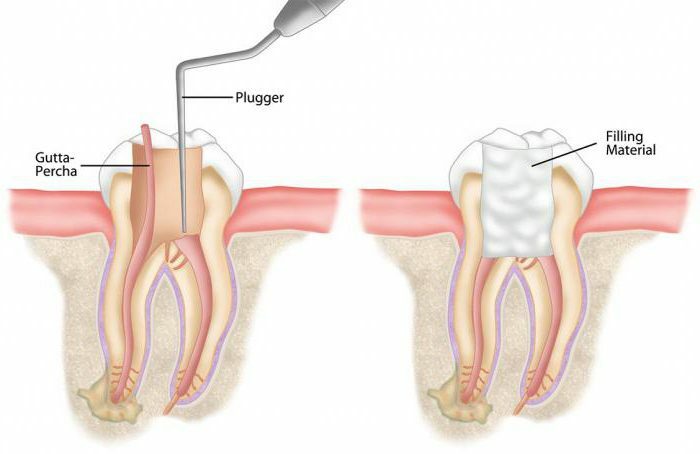 sealing the root canal with gutta-percha