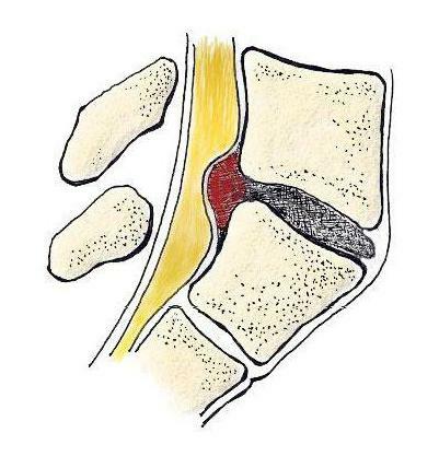 الفتق الظهرية للقرص ما هو عليه