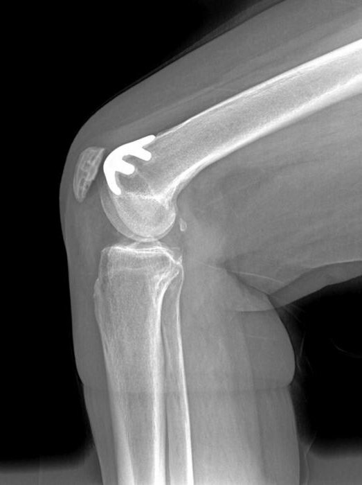 patellofemoral arthrosis of the knee joint