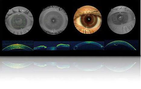 optická koherentná tomografia