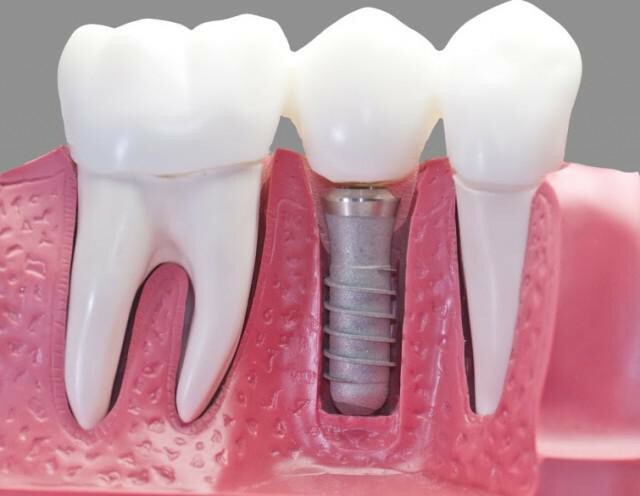 dentistry implant city reviews