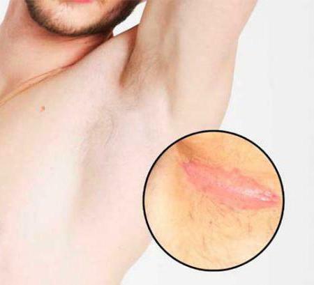 what does the rash under the armpits look like in adults