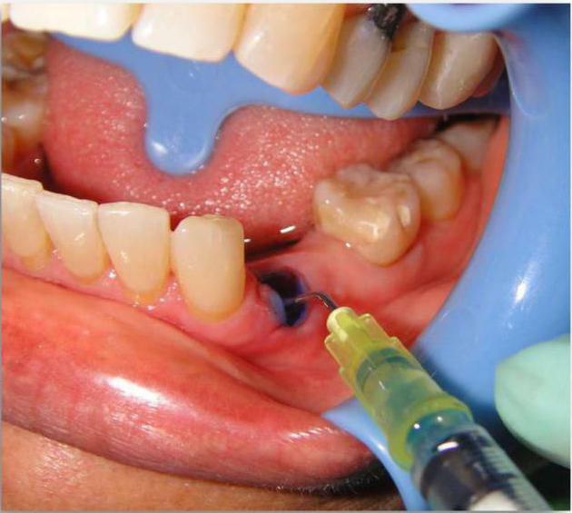 apikal periodontitisin teşhisi