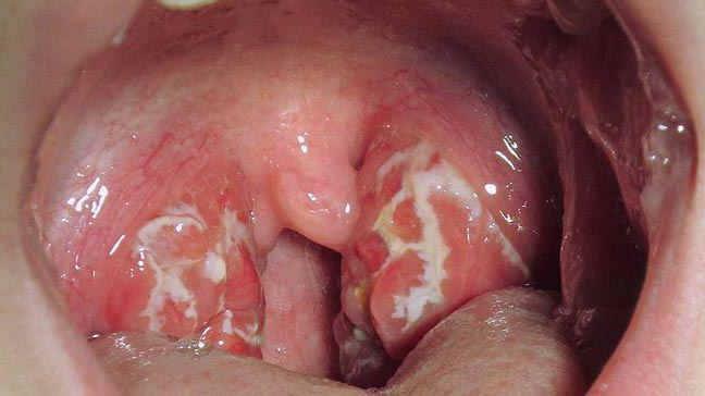 how to treat herpes sore throat