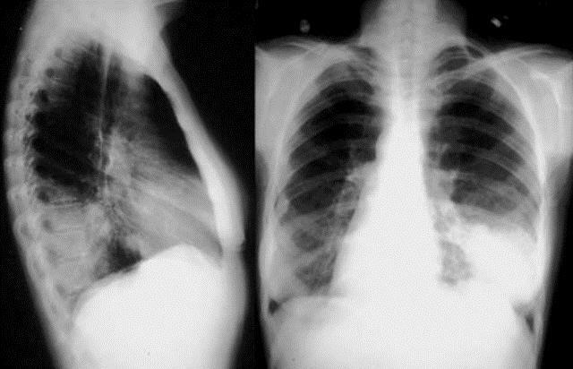 Klebsiella pneumoniae dalam urin