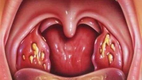 inflammation of tonsils treatment