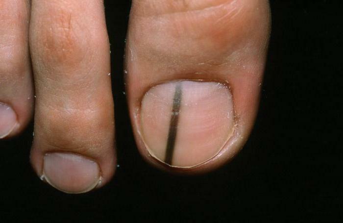 Melanoma of the nail