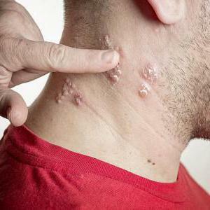 complications of chicken pox in adults