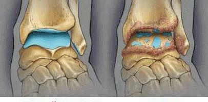 Post-traumatic arthrosis of the ankle joint of the 2nd degree