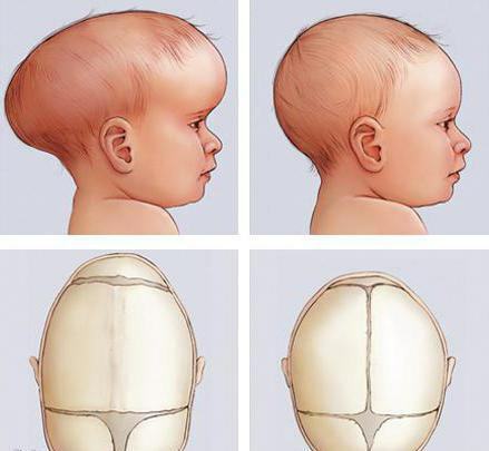 forma dolgiocefalica della testa nel feto