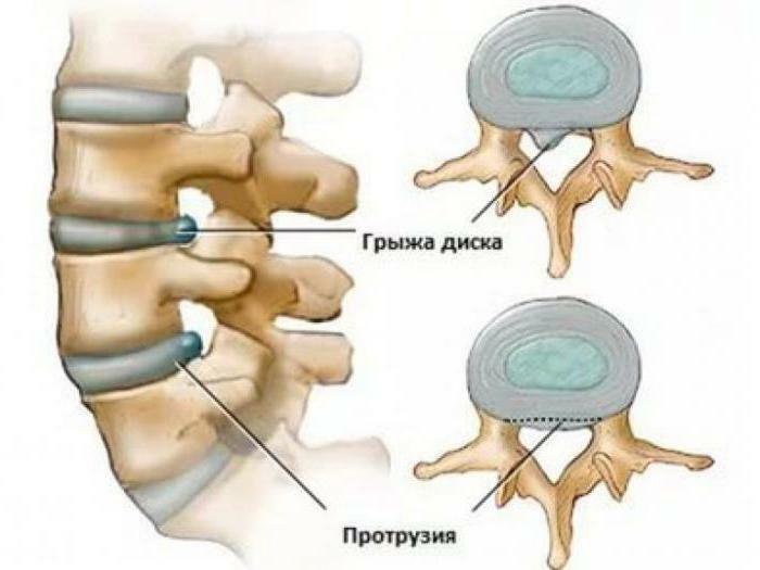 Грыжа мпд картинки